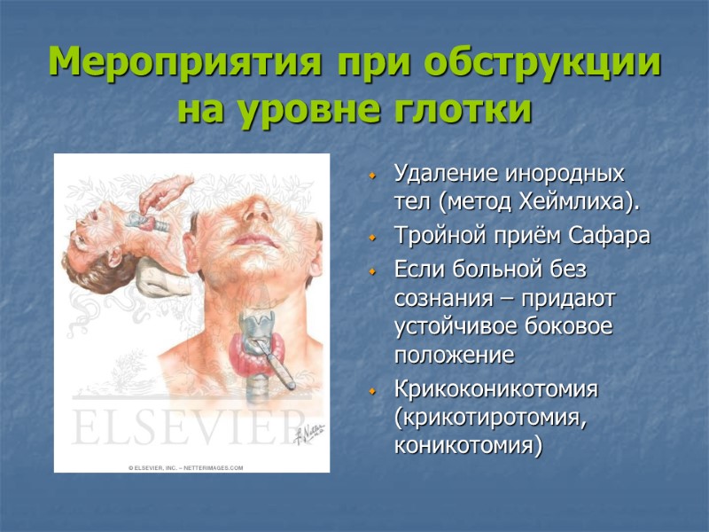 Мероприятия при обструкции на уровне глотки  Удаление инородных тел (метод Хеймлиха).  Тройной